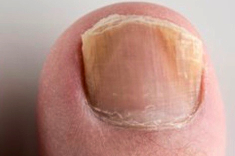SF Fungal Nail Treatment Clinic