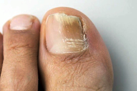 SF Fungal Nail Treatment Clinic