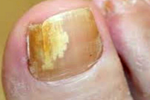 SF Fungal Nail Treatment Clinic
