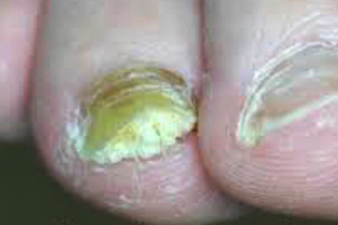 SF Fungal Nail Treatment Clinic