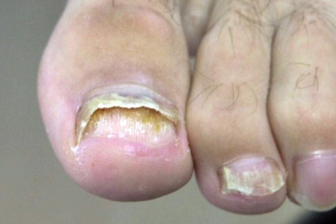 SF Fungal Nail Treatment Clinic