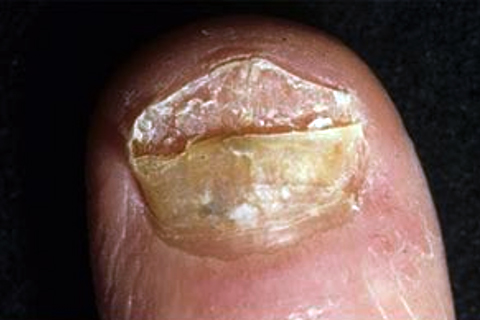 SF Fungal Nail Treatment Clinic
